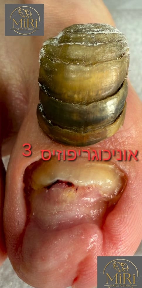 תוצאת טיפול בקליניקה — לפני ואחרי