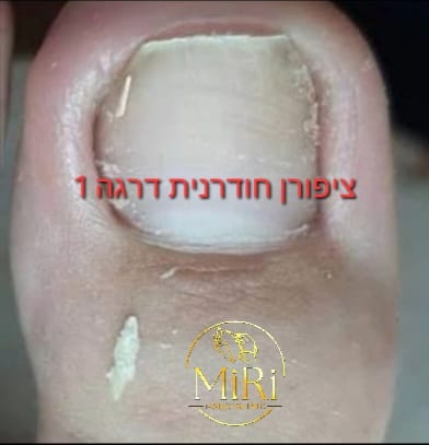 תוצאת טיפול בקליניקה — לפני ואחרי